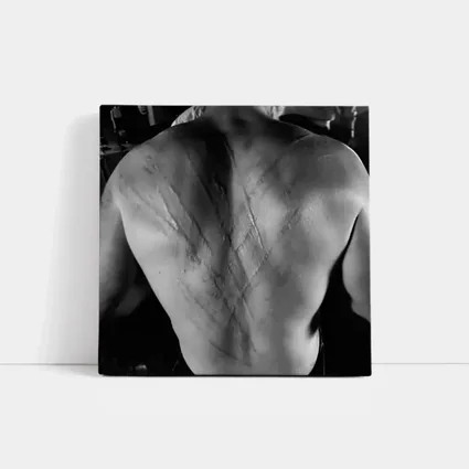 Scarred Male Back Black White Photography