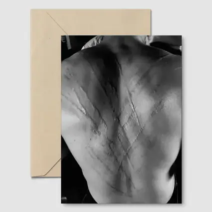 Scarred Male Back Black White Photography